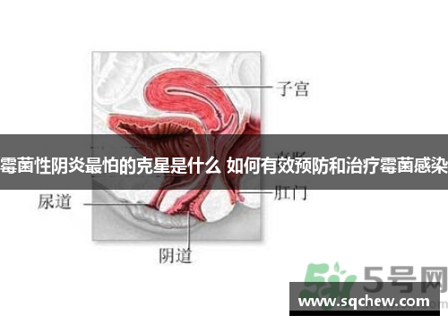 霉菌性阴炎最怕的克星是什么 如何有效预防和治疗霉菌感染